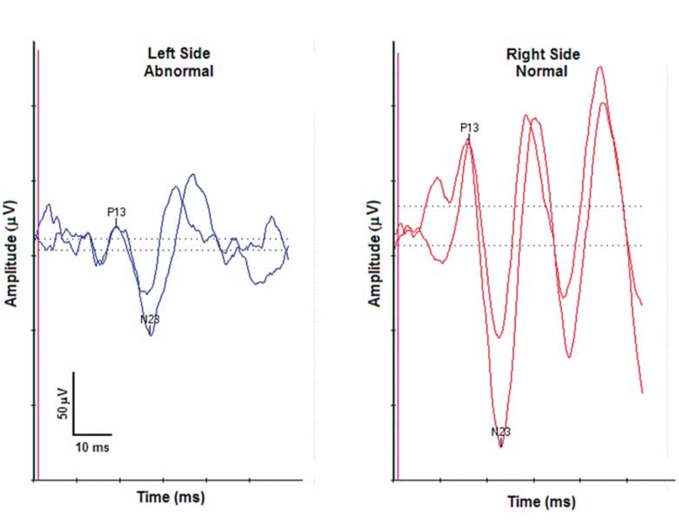 NEW CPT Codes for Ocular and Cervical VEMP in 2021 MedAudPro